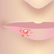 Dritte Phase von Lippenherpes